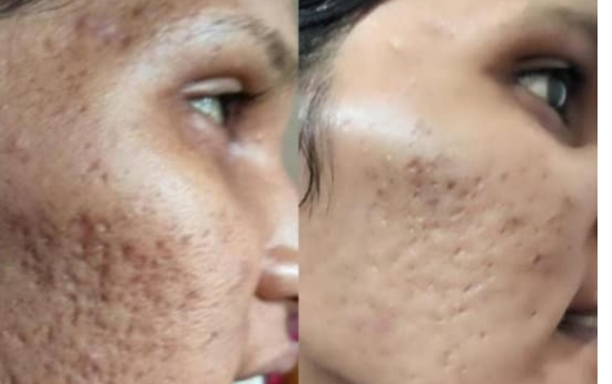Before After