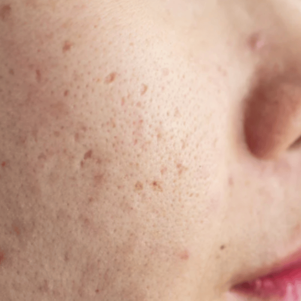 Post Acne Dark Marks