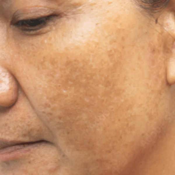 Melasma Hormonal Pigmentation