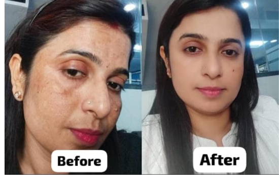 Before After