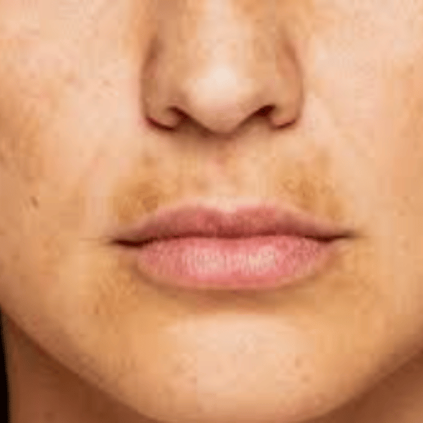 Uneven Skin Tone