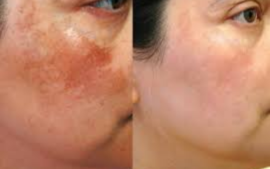 Before After